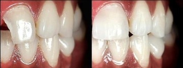 Before and after close-ups of teeth, demonstrating the successful restoration of a patient's smile with improved aesthetics and function.