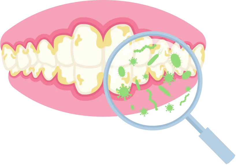 Illustration of teeth with bacteria buildup, highlighting the need for oral prophylaxis.