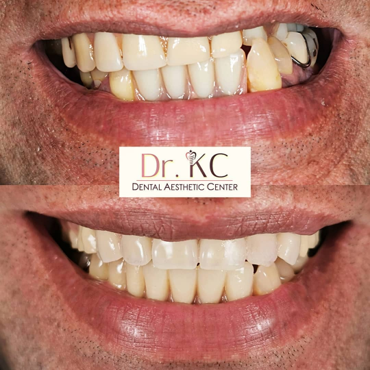 Close-up of a smile enhanced with natural-looking porcelain veneers and crowns.