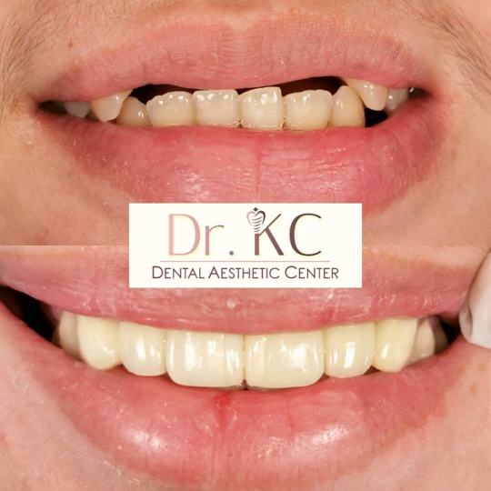 A close-up image showcasing a smile after treatment with porcelain veneers and crowns, highlighting the natural appearance and improved aesthetics.