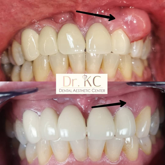 Before and after image of successful gum treatment at Dr. KC Dental Aesthetic Center.