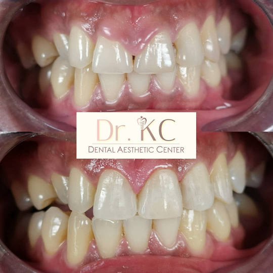 Before and after image of successful gum treatment at Dr. KC Dental Aesthetic Center.