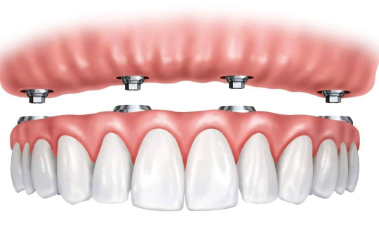 Close-up of dental implants model.