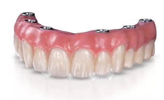 Close-up of dental implants model.