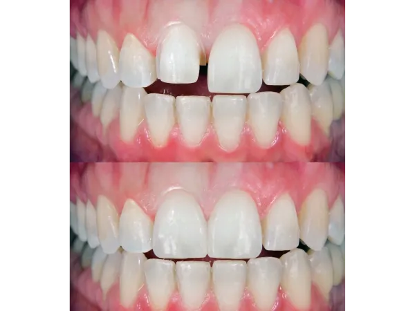 Before and after photos showing dental crown restoration.