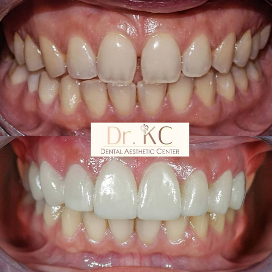 Before and after photos demonstrating the transformative effect of porcelain veneers and crowns on a smile.