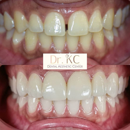 Before and after results of porcelain veneer/crown treatment.