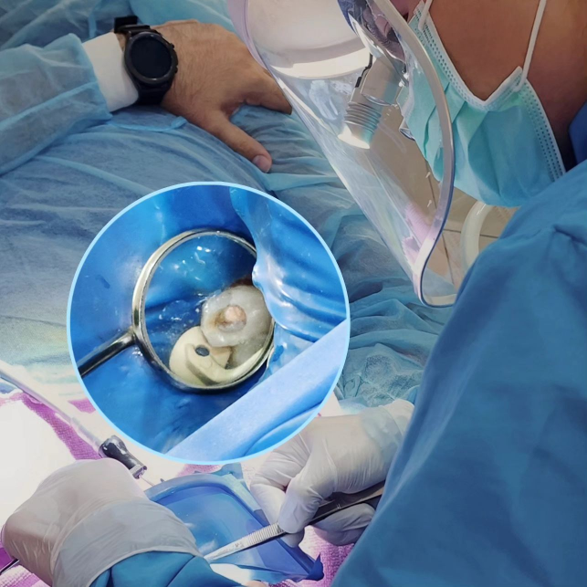 Gentle root canal therapy to preserve a natural tooth and relieve pain.