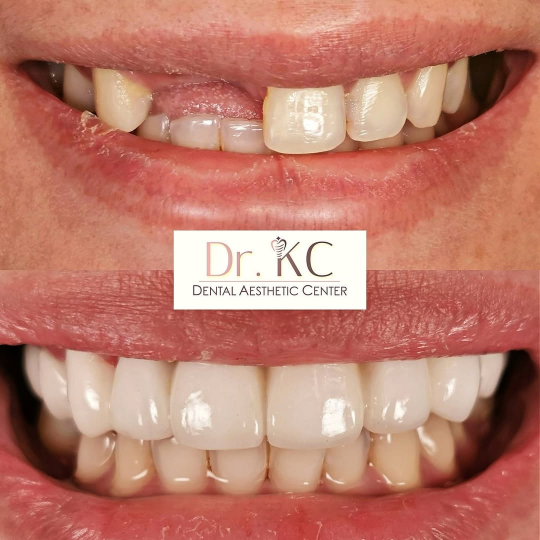 Before and after photos demonstrating the transformative effect of zirconia veneers, crowns, or bridges on a smile.