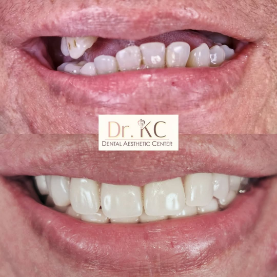 Close-up showing teeth with damage before treatment with zirconia veneers, crowns, or bridges.